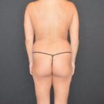 Fat Transfer to the Buttocks - Case 13548 - Before