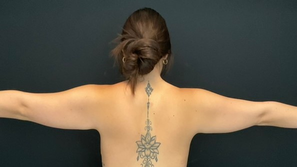 Arm Lift Patient Photo - Case 14024 - before view-